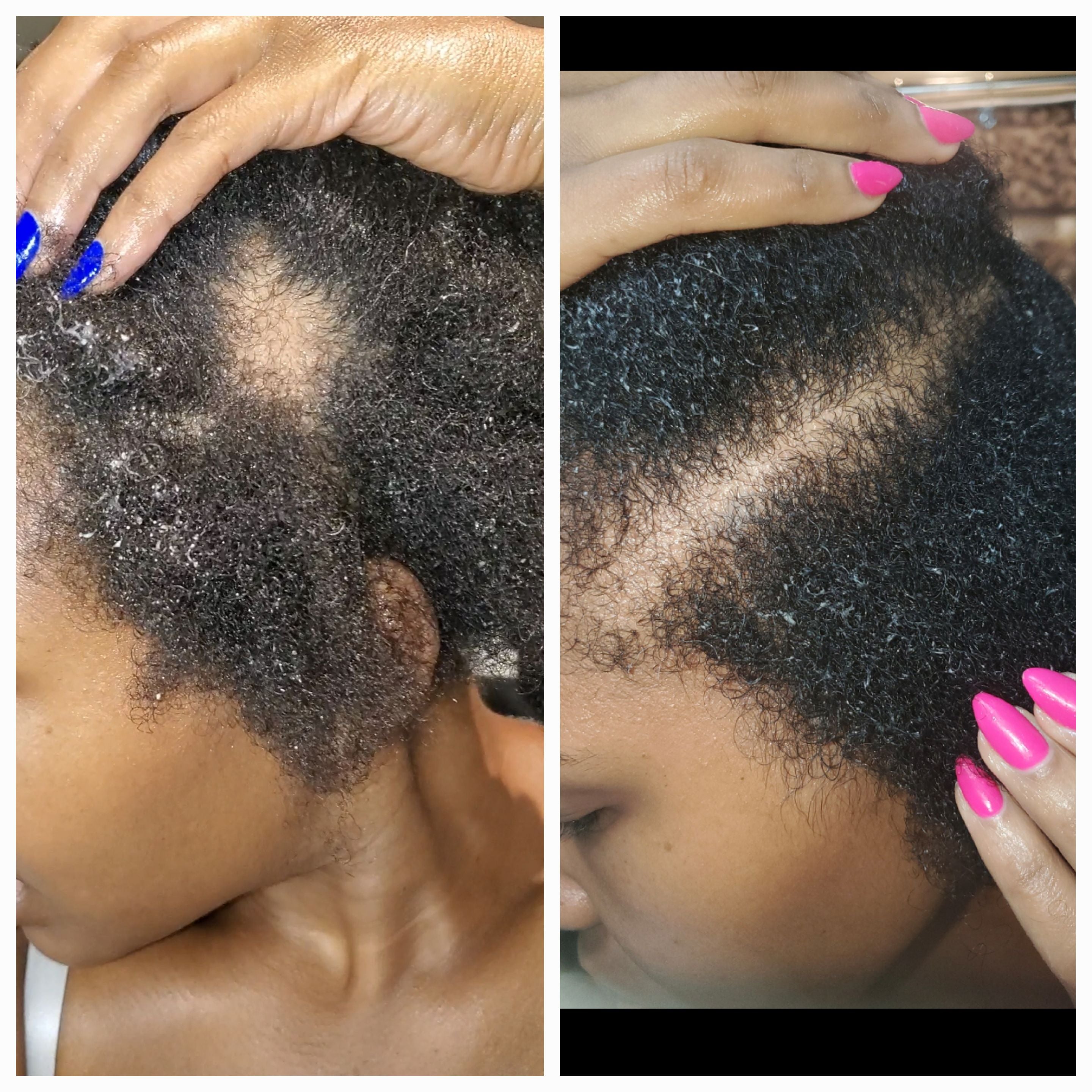 Before and after photos using scalp serum